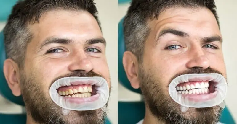 Teeth Whitening Options in Marmaris: Brighten Your Smile Safely Teeth Whitening Options in Marmaris: Brighten Your Smile Safely