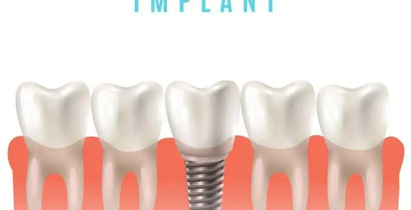 How much does it cost to get a full mouth of dental implants in Turkey