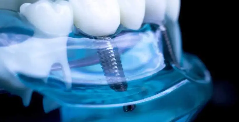 How Long Do Dental Implants Last? Lifespan, Maintenance & Long-Term Care