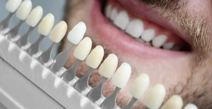 Can veneers be done in one day?