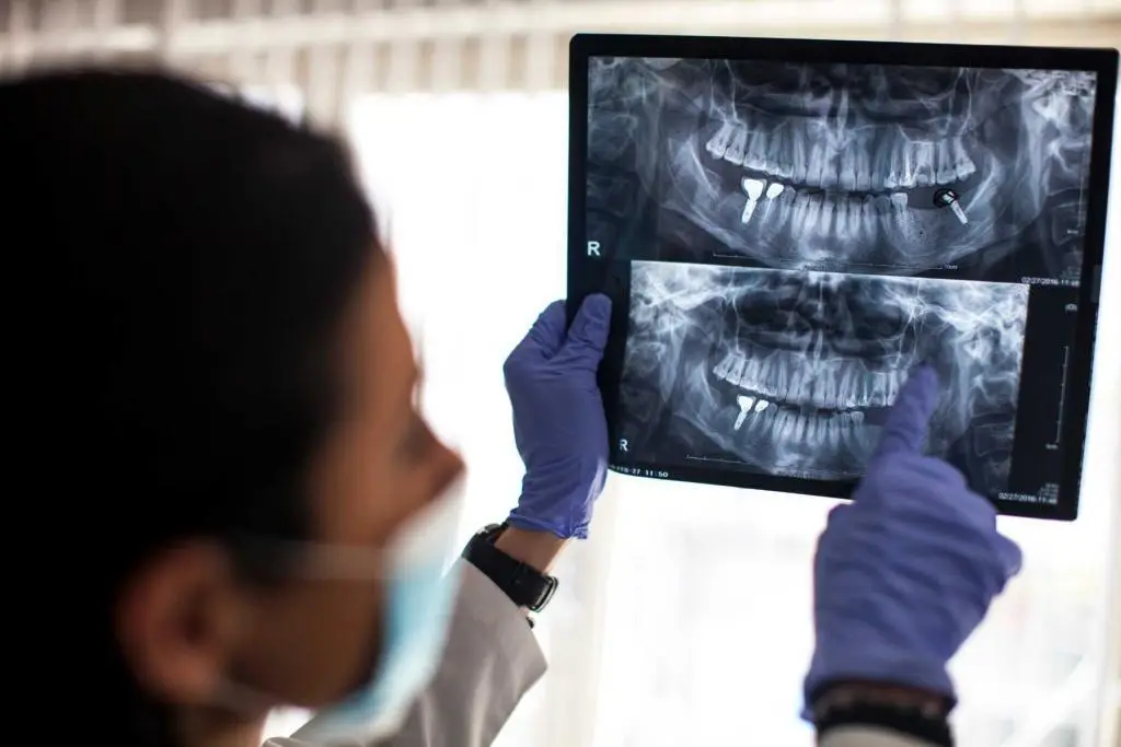 Full mouth dental implants in Turkey