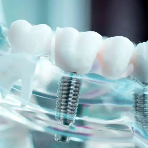 Dental implants in Turkey