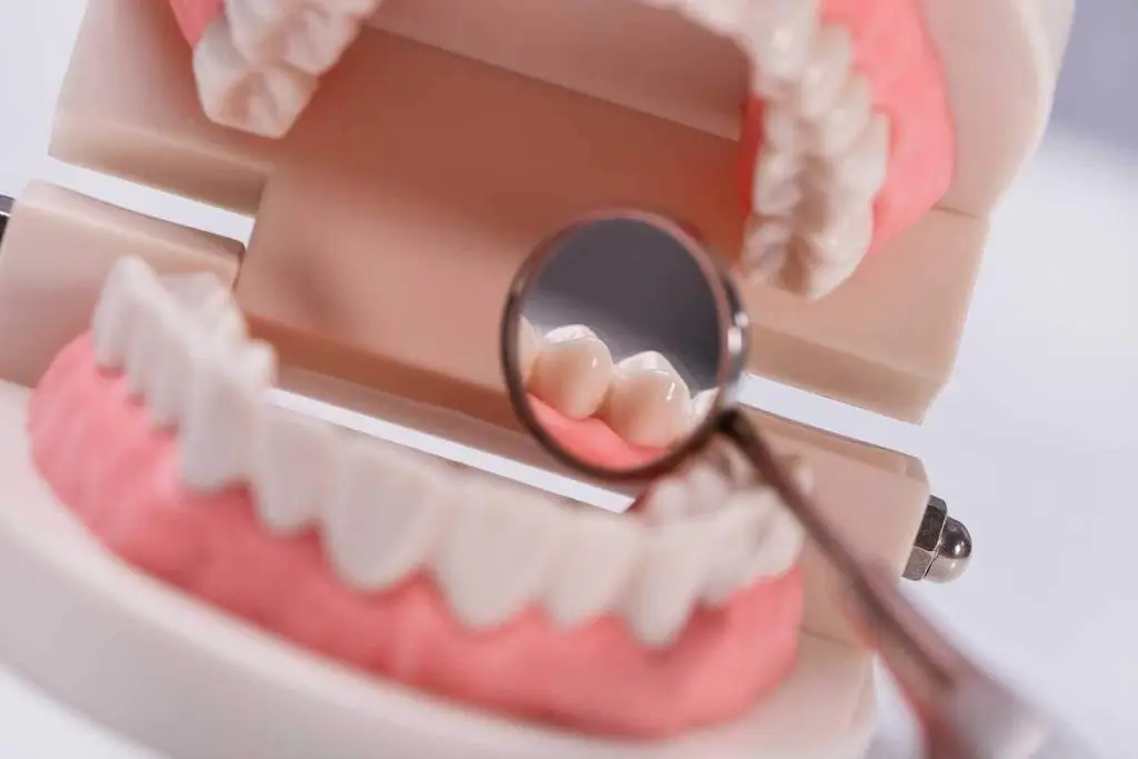 Dental bridge treatment
