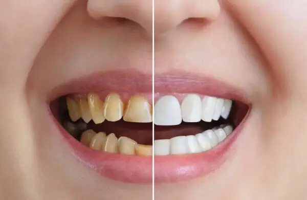 Composite Bonding or Dental Veneers: Which Is Right for You?