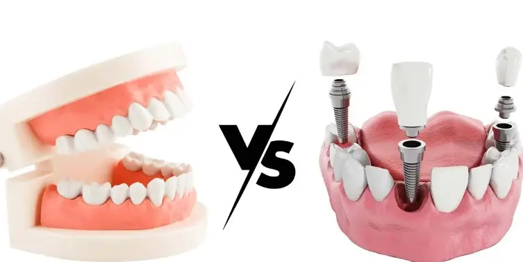 DENTURES VS. DENTAL IMPLANTS: WHICH IS BEST FOR YOU?