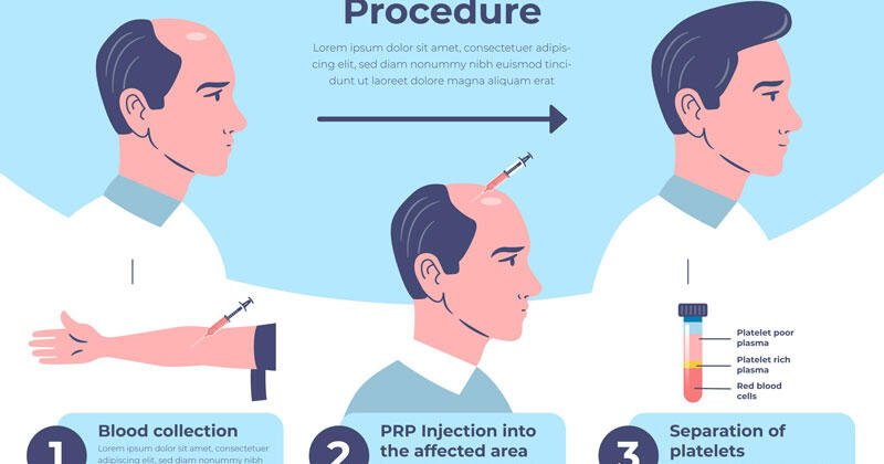 The Hair Transplant Process: Healing Time and Post-Transplant Care