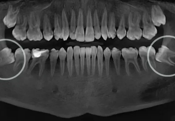 Wisdom Teeth (Third Molars): Symptoms, Treatment Options, and When Extraction Is Recommended